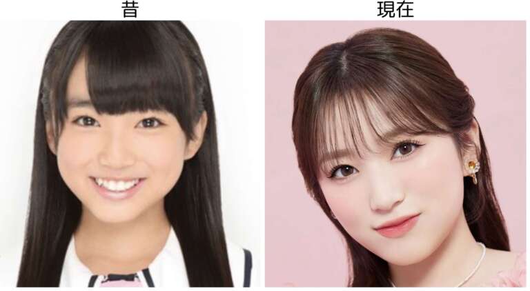 矢吹奈子 整形